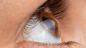 Augenlasern Hornhautverkrümmung